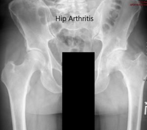 Preoperative X-ray of the pelvis showing AP view of the pelvis with both hips