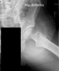 Preoperative X-ray of the left hip in AP and frog-legged lateral views