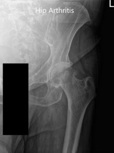 Preoperative X-ray of the left hip showing AP and frog-legged lateral view