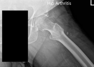 Preoperative X-ray of the left hip showing AP and frog-legged lateral view - img 2