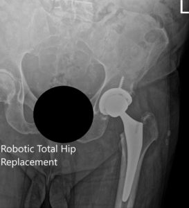 Postoperative X-ray of the left hip showing AP and frog-legged lateral view
