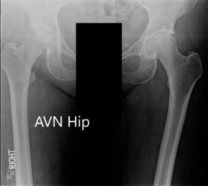 X-ray showing the AP view of the pelvis with both hip joints