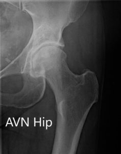 X-ray showing the AP and frog-legged lateral views of the left hip joint