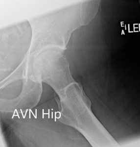 X-ray showing the AP and frog-legged lateral views of the left hip joint - img 2