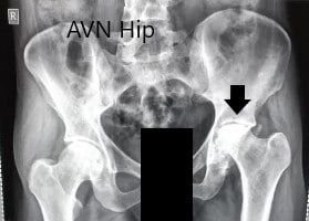 Preoperative X-ray of the pelvis with both hips in anteroposterior view
