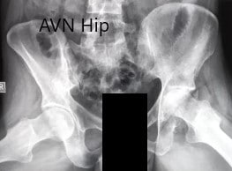 Preoperative X-ray of the pelvis with both hips in frog-legged lateral views