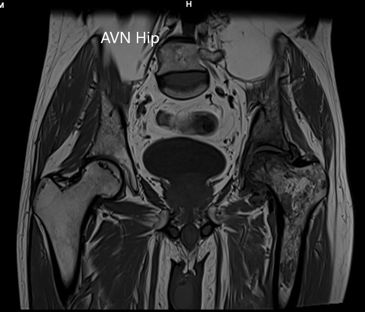 MRI showing the T1WI of the pelvis
