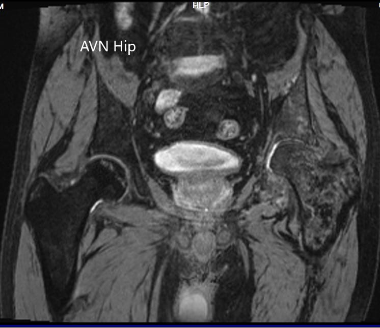 MRI showing the T2WI of the pelvis