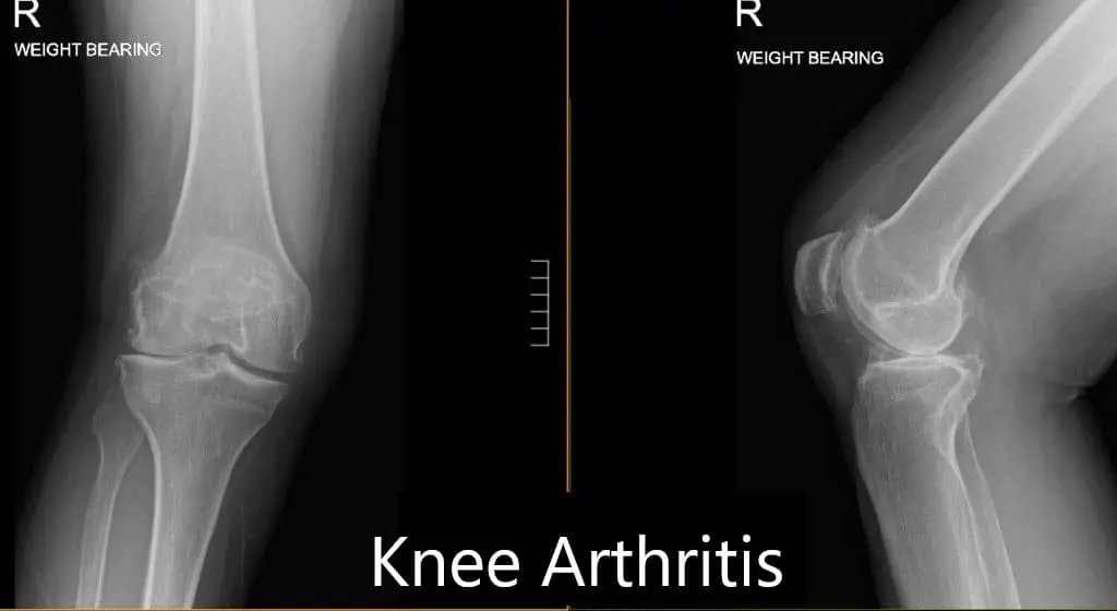Right total knee arthroplasty