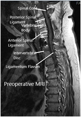 Preoperative MRI in the sagittal section