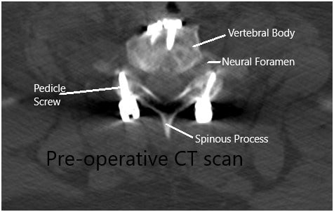 Preoperative CT scan in the axial section