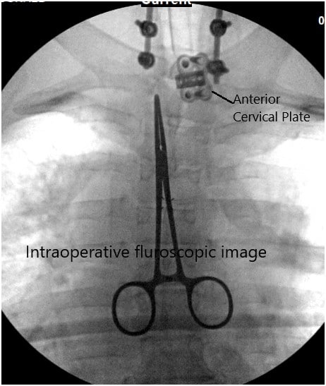 Intraoperative fluoroscopic image