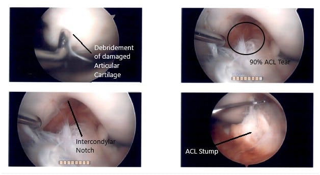 Intraoperative Arthroscopic Images of the left knee