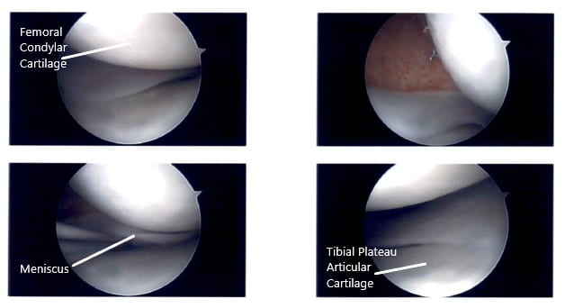 Intraoperative Arthroscopic Images of the left knee 2