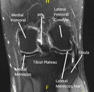 MRI of the Knee in coronal and sagittal sections