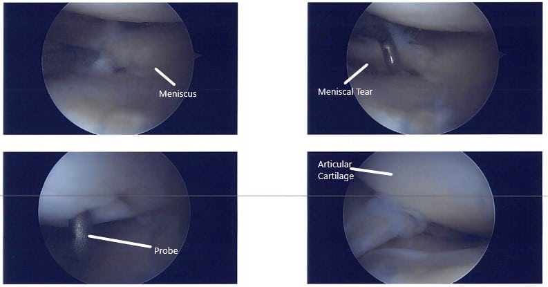 Intraoperative arthroscopic images