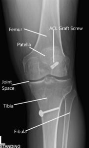 X-ray of the left knee in AP and Lateral views