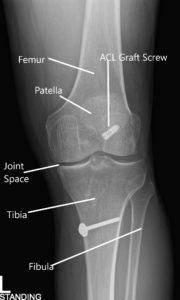 Radiografía de la rodilla izquierda en AP y vistas laterales