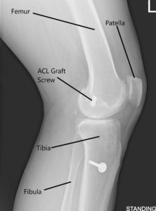 Radiografía de la rodilla izquierda en AP y vistas laterales