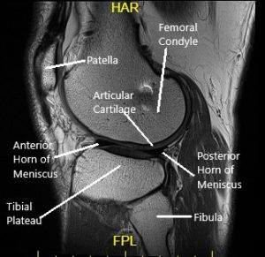 Sagittal MRI view of the left knee