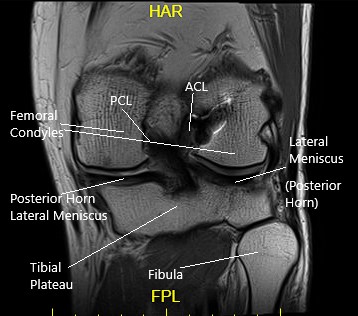 Coronal MRI view of the left knee