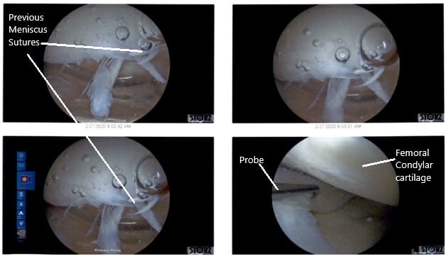 Intraoperative Arthroscopic Views of the left knee