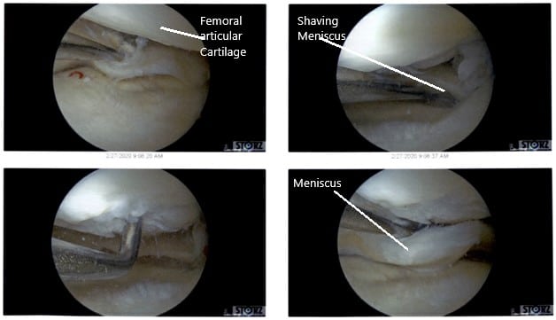 Intraoperative Arthroscopic Views of the left knee 2