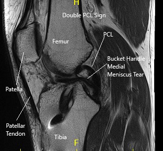 MRI of the right knee in the sagittal and coronal section