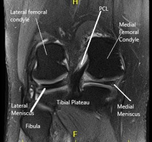 MRI of the right knee in the sagittal and coronal section