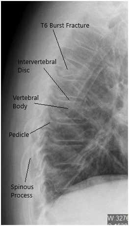 Preoperative X-ray of the Thoracolumbar Spine in Lateral View