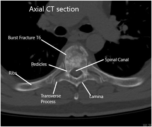 Preoperative CT Scan of the Thoracolumbar Spine in Axial Section at T6