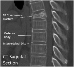 CT Sagittal and coronal Sections
