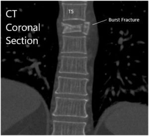 CT Sagittal and coronal Sections 2