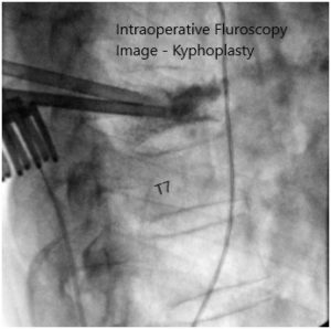 Intraoperative fluoroscopy images 2