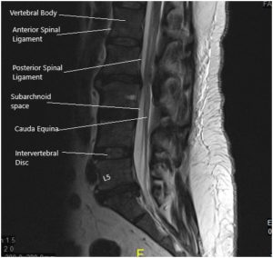 MRI of the lumbosacral spine in sagittal and axial views