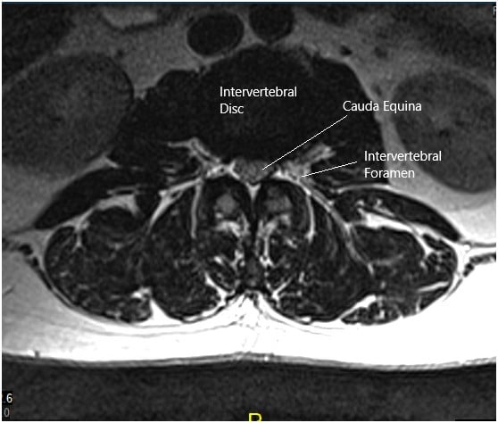 MRI of the lumbosacral spine in sagittal and axial views 2