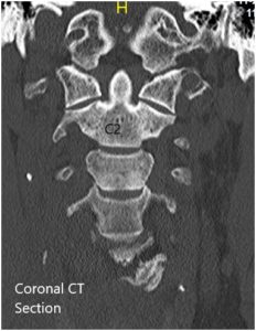 Preoperative Coronal and Axial CT sections