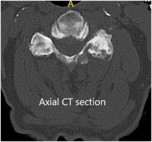 Preoperative Coronal and Axial CT sections 2