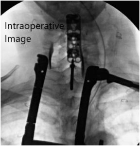 Intraoperative fluoroscopic images 3