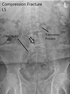 X-ray of LS spine in AP and Lateral views showing significant compression fracture L5