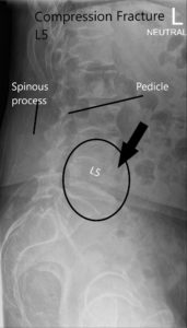 X-ray of LS spine in AP and Lateral views showing significant compression fracture L5 2