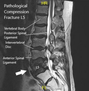MRI showing Sagittal Section of Lumbar Sacral Spine