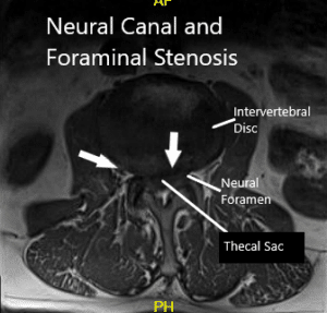 MRI showing Axial Section