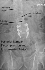 Postoperative X-ray showing AP and Lateral Views