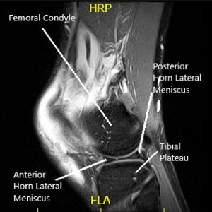 Resonancia magnética de la rodilla izquierda en la vista sagital y coronal