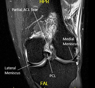 MRI of the left knee in the sagittal and coronal view 2