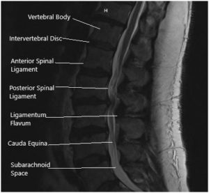 MRI of the Lumbosacral spine in sagittal and axial sections