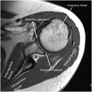 MRI image of the shoulder in axial and coronal sections