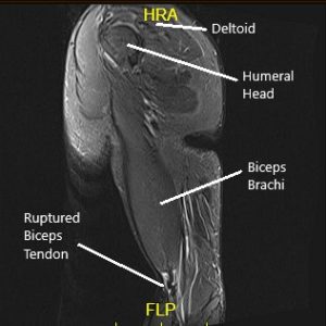 MRI showing the bicep tendon rupture