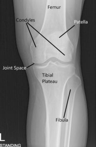 X-ray of the knee in AP and skyline view